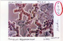 dr_mark_siegal_blood1 dr_mark_siegal_blood1