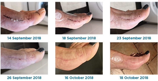 Healing After Foot Surgery