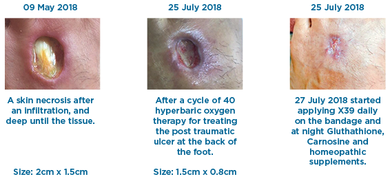 Healing Skin Necrosis