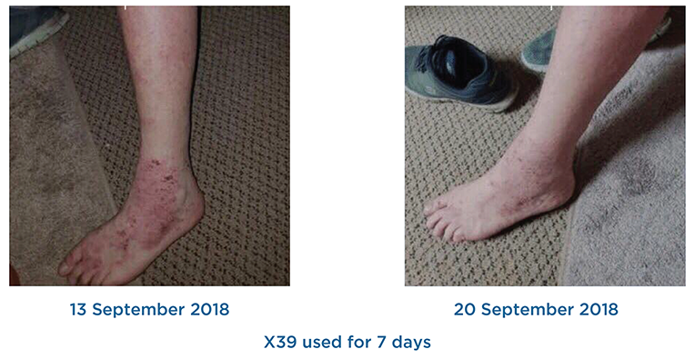 Rapid Psoriasis Healing