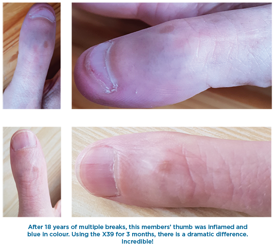 Healing Inflamed Thumb