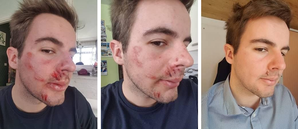 healing after snowboarding accident