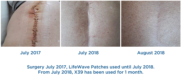 Rapid Healing from Surgery